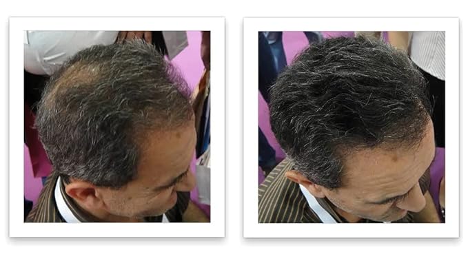 Trial Size - Eliminate Bald Spot and Thinning Hair Instantly. Make Thin Hair Look 10X Fuller. All-Natural Hair Thickening Fiber. Salt & Pepper - Dark