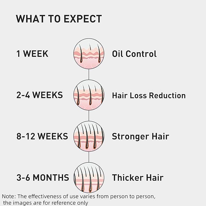 0.5% KINTOR KX-826 Hair Growth Spray,Oil Control Strengthen Hair,Hair Regrowth Products for Women&Men,Basic,300ml