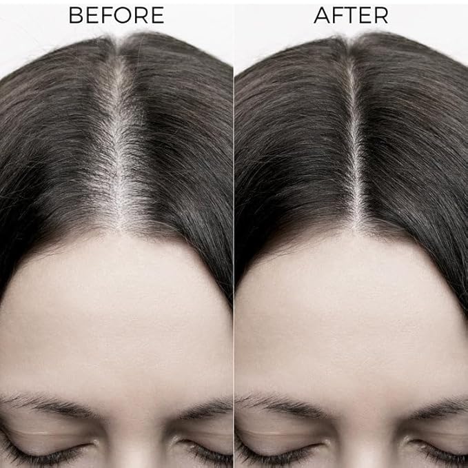 Nova Bloom Brillares Onion & Bakuchiol Hair Oil Shots | Nourishing Scalp Treatment for Stronger Hair | Helps Reduce Hair Breakage & Improve Texture | Lightweight, Non-Greasy Formula | For Men & Women