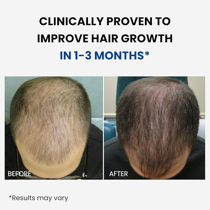 ForHair- Men Hair Growth Spray – Stimulates New Hair, Strengthens Follicles – Local Regrowth Action, No Unwanted Body Hair – Safe and Easy Alternative to Pills,Costly and Painful Treatments
