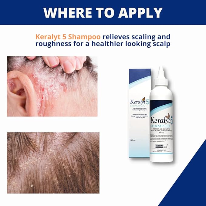 5 Anti-Dandruff Shampoo - Max Strength 5% Salicylic Acid Scalp Build-Up Clearing - Promotes Relief from Dandruff, Psoriasis, Seborrheic Dermatitis, Dryness, and Itchiness, 177 milliliters