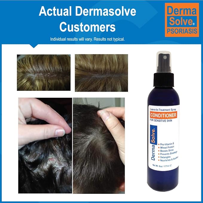 Dermasolve Psoriasis Leave-In-Treatment and Styling Spray Conditioner for Seborrheic Dermatitis, Sensitive Skin, Detangle, De-Flake, Soothing Anti Dandruff, Dry Scalp Repair for Damaged Hair