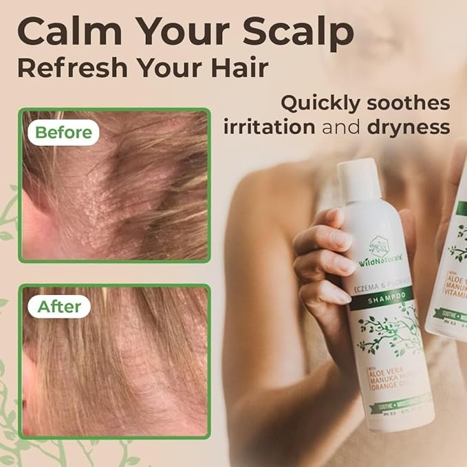 Wild Naturals Psoriasis Shampoo for Scalp Care & Relief – Hydrating Anti-Dandruff Shampoo for Itchy, Dry Scalp – Gentle Eczema Shampoo for Sensitive Skin