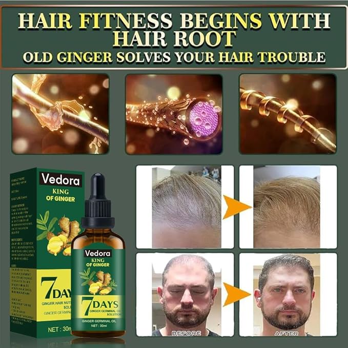 Vedora Ginger Oil for Hair Growth - Promotes Strong, Thick, Long Hair with Essential Ginger Serum - For Men & Women - 5.25 Fl Oz / 150ML (5pc)
