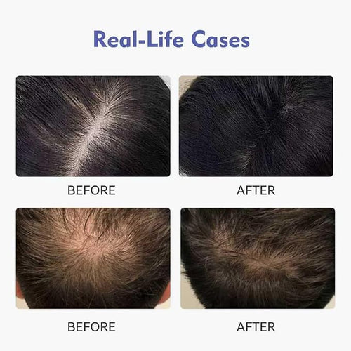 0.9% KX-826 KINTOR Hair Growth Products Foam, DHT Blocker for Men & Women Hair Regrowth, 240ml Pro