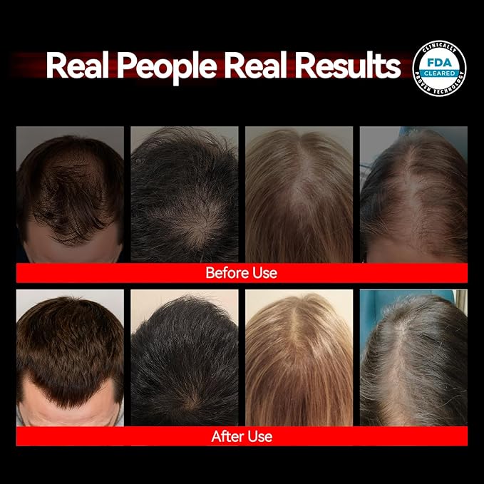 Red Light Therapy for Hair Growth, Laser Cap Red Light Higher Dose for Hair Regrowth FDA Cleared for Hair Loss Treatment LLLT Hair Thinning & Alopecia for Men Women