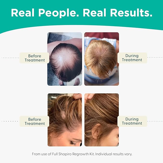 Shapiro MD Hair Growth Experts Hair Loss Conditioner, DHT Fighting Vegan Formula for Thinning Hair Developed by Dermatologists, Experience Healthier and Thicker Looking Hair - 4 Month Supply