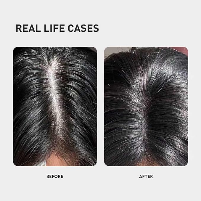 0.9% KX-826 KINTOR Hair Growth Products Foam, DHT Blocker for Men & Women Hair Regrowth, 180ml Pro