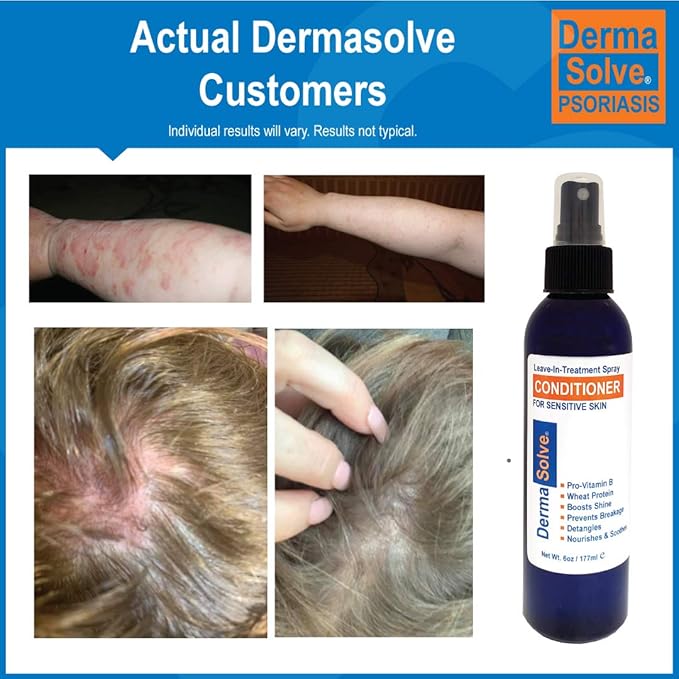 Dermasolve Psoriasis Leave-In-Treatment and Styling Spray Conditioner for Seborrheic Dermatitis, Sensitive Skin, Detangle, De-Flake, Soothing Anti Dandruff, Dry Scalp Repair for Damaged Hair