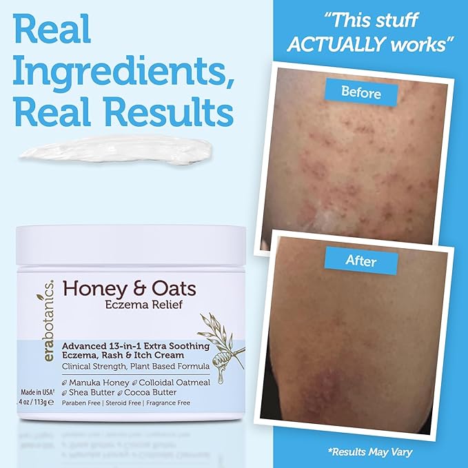 Eczema Cream with Manuka Honey & Colloidal Oatmeal – Extra Strength Anti Itch Cream for Dry, Sensitive Skin – Dermatitis & Itchy Skin Relief Moisturizer for Adults & Kids– Steroid Free Face & Body Use