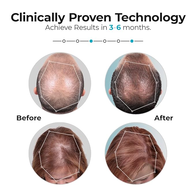 Capillus Pro Mobile Laser Therapy Cap for Hair Regrowth, with 272 Red Light Lasers for Laser Hair Growth, Red Light Hair Growth