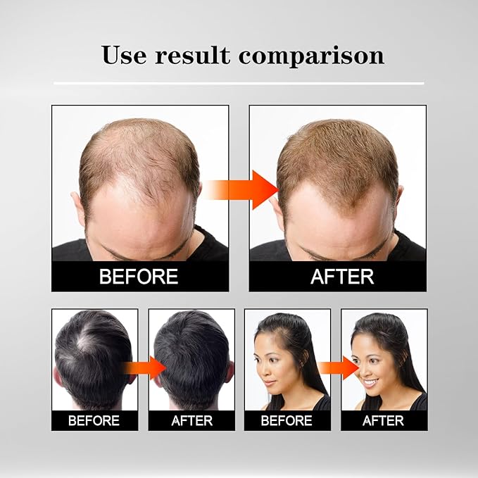 5% Minoxidil Hair Liquid for Men & Women, 2 x 3ml, with Ginseng & Ginger Root Extract - Hair Growth Supporting Treatment for Thinning Hair, Scalp Care Serum to Help Reduce Hair Loss Appearance