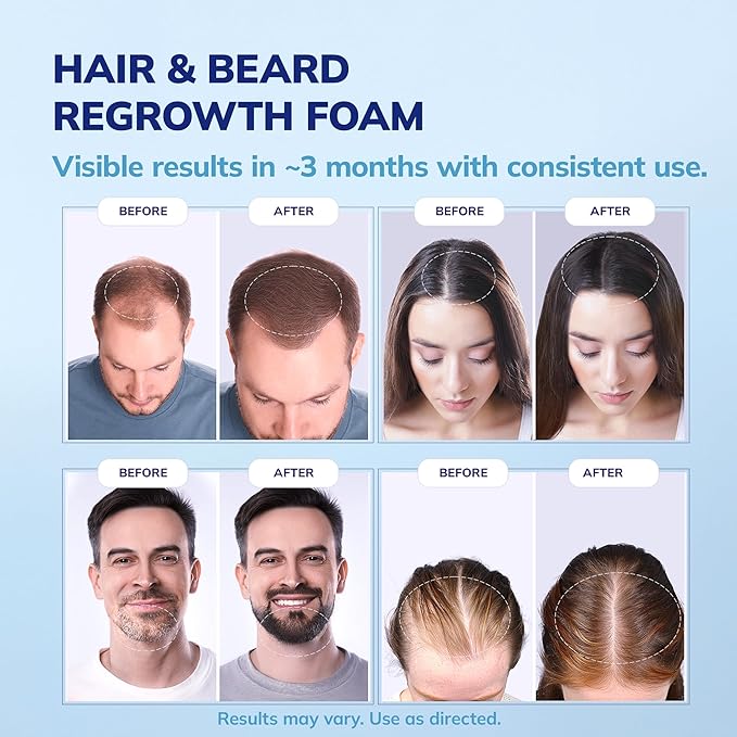 5% Minoxidil Foam for men and women, Extra Strength Hair Regrowth Treatment for Thinning Hair and Hair Loss, Hair Follicle Health – Thicker, Fuller Hair Growth Solution 6 FL.OZ