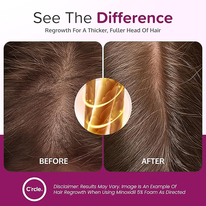 Minoxidil for Women 5% Foam - Helps Restore Top of Scalp Hair Loss and Support Hair Growth for Women, Regrowth with Unscented Topical Treatment for Thinning Hair (5% Foam 8-Month Supply)