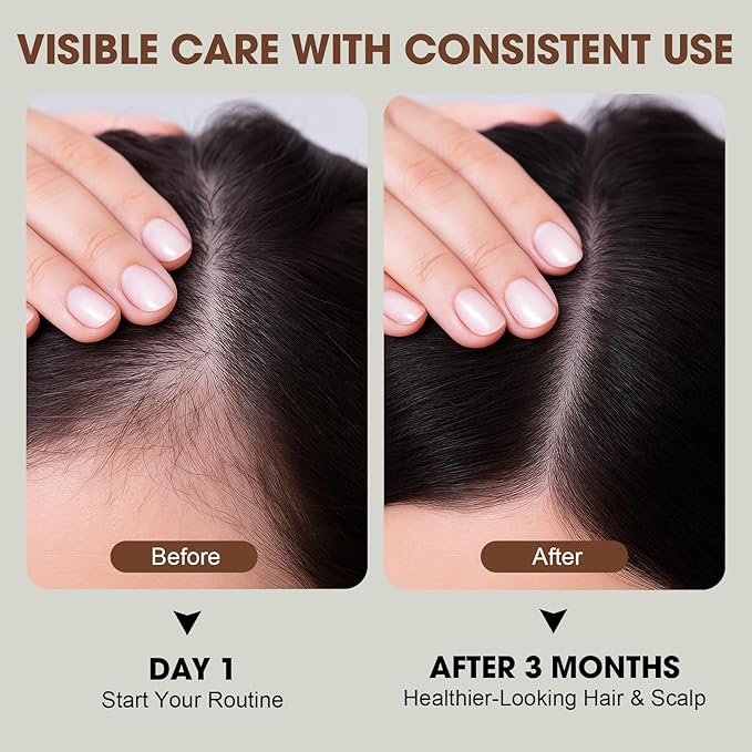 PP405 Hair Treatment – Lightweight Scalp Serum for Fuller-Looking Hair, Non-Greasy Formula with Hyaluronic Acid & Biotin, For Men & Women