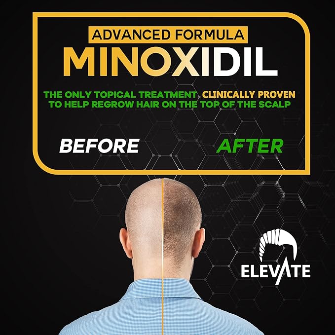 ELEVATE 5% Minoxidil Hair Growth Spray - Alcohol Free Non Oily Formula Extra Strength Professional Treatment for Hair Loss/Regrowth - Stimulate Hair Follicles for Men & Women - 1 Month Supply
