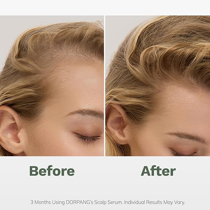 Scalp Serum for Thinning Hair in Men & Women, Clinically Tested Vegan Formula with Peptides & Rosemary Oil, Improves Hair Density and Scalp Health, Non-Greasy No-Rinse Christmas Gift