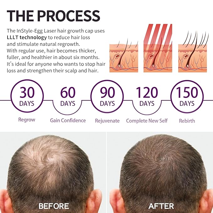 Instyle Egg Laser Hair Growth Cap – 80 Medical-Grade Diodes, FDA Cleared LLLT Red Light Therapy for Hair Regrowth & Thicker Hair, Hair Loss Treatment for Men & Women