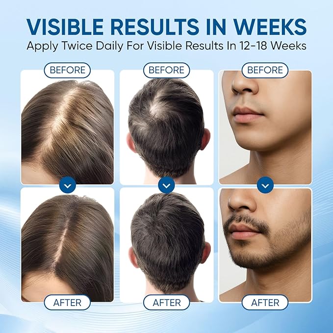 Rosemary Scalpy Hair Growth Serum Roll On, Hair Revival Ampoule, Hair Regrowth Roller for Fuller, Thicker, Stronger Hair, Repair Hairline & Thinning Hair for Men & Women (2 Pack)