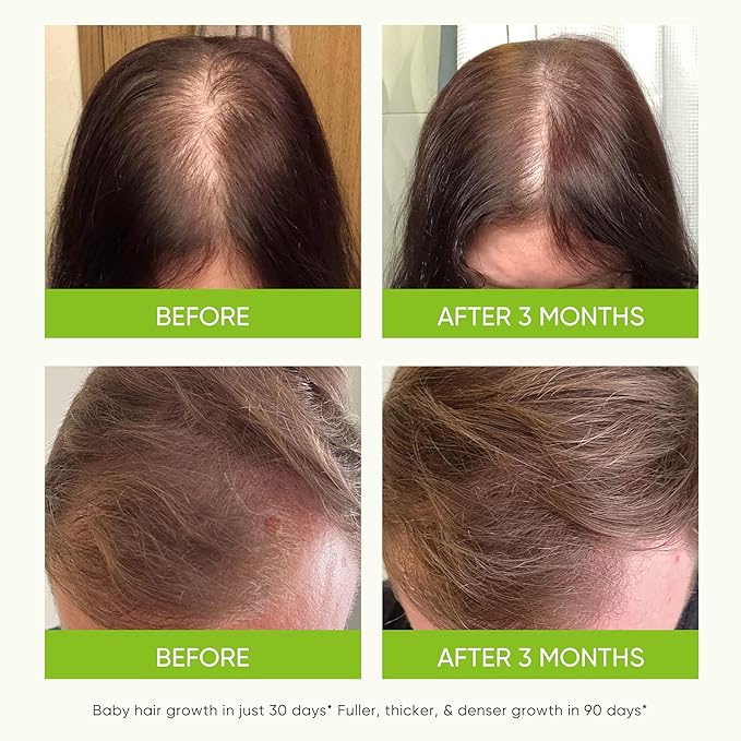 Svvimer Hair Growth Serum Spray - with Rosemary Batana Oil Biotin for Hair Loss and Thinning Hair - Thicker Fuller Hair for Women Men 2 Fl Oz (Pack of 1)