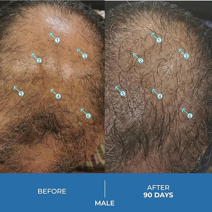 DS Labs Spectral.UHP 5% Minoxidil Hair Density Serum for Men - Extra Strength Topical Formula for Thicker-Looking Hair, Targets Thinning at the Crown Area, With Nanosome Technology, 60mL