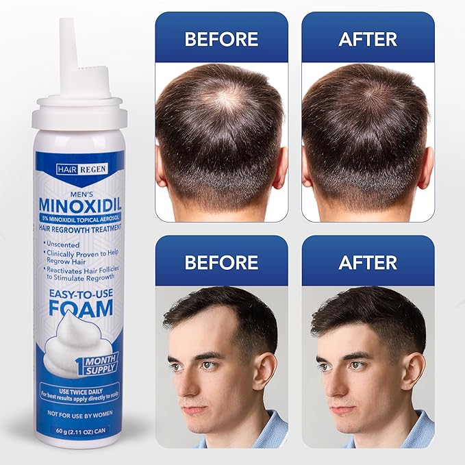 Minoxidil Foam for Men 5% Percent - Men's Hair Growth Treatment for Him- Topical Foaming Minoxidil for Men- Great for Hair Regrowth and Reduce Hair Loss - 1 Pack as 1 Month Supply